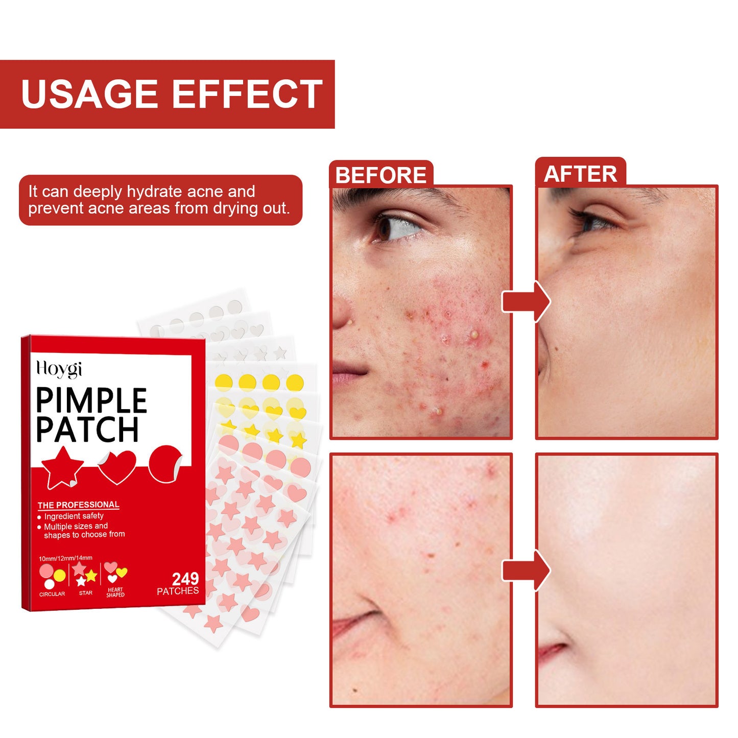 Hoygi facial color acne patch deeply moisturizes, reduces acne, repairs skin barrier, cute pattern