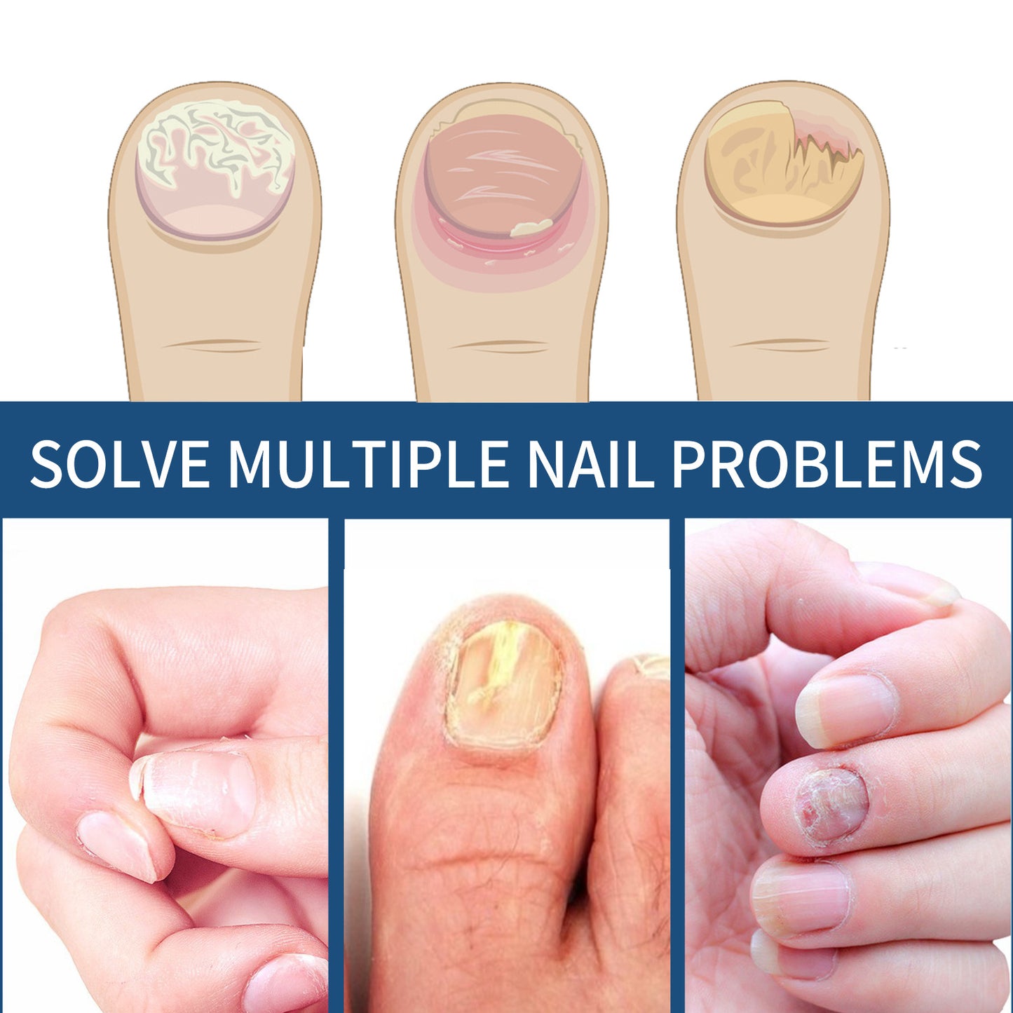 EELHOE Toenail Repair Patch Onychomycosis Care Toenail Soft Nail Ingrown Toenail Thickening Bright Nail Groove Repair Patch