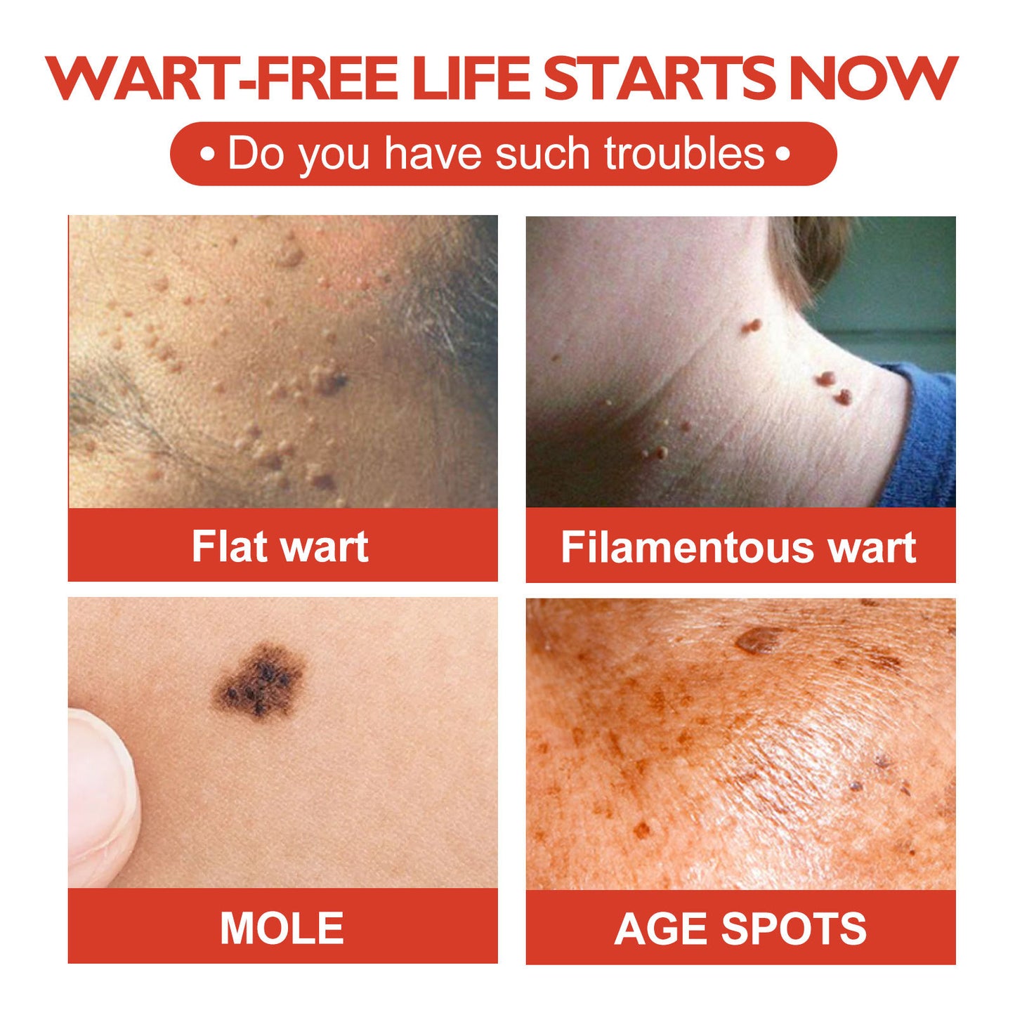 OUHOE Acne Patch Skin Clearing Pimples ဝက်ခြံ အမည်းရောင် မှဲ့များ ပြုပြင်ခြင်း အရေပြား အမှတ်များ ကြွက်နို့ ပြောင်းဖူး အစက်အပြောက် Patch