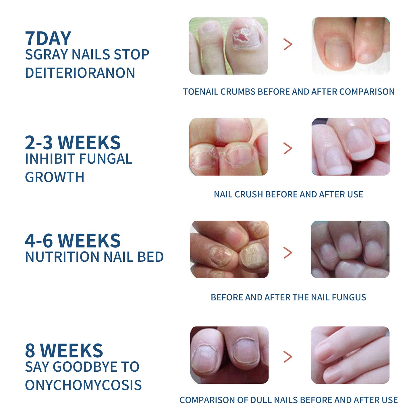 EELHOE Toenail Repair Patch Onychomycosis Care Toenail Soft Nail Ingrown Toenail Thickening Bright Nail Groove Repair Patch
