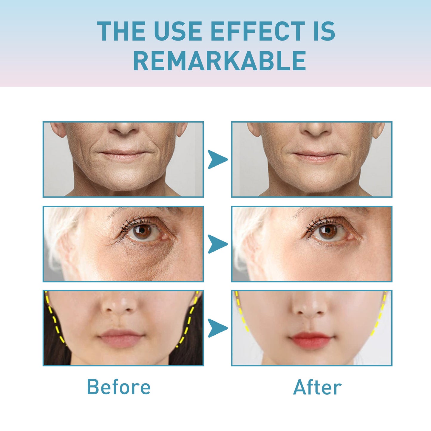 OUHOE Collagen Anti-Wrinkle Cream သည် အသားအရေကို ချောမွေ့စေပြီး အစိုဓာတ်ထိန်းပေးခြင်း၊ တင်းရင်းစေပြီး နုပျိုစေပြီး အိုမင်းရင့်ရော်မှုကို တားဆီးပေးပါသည်။