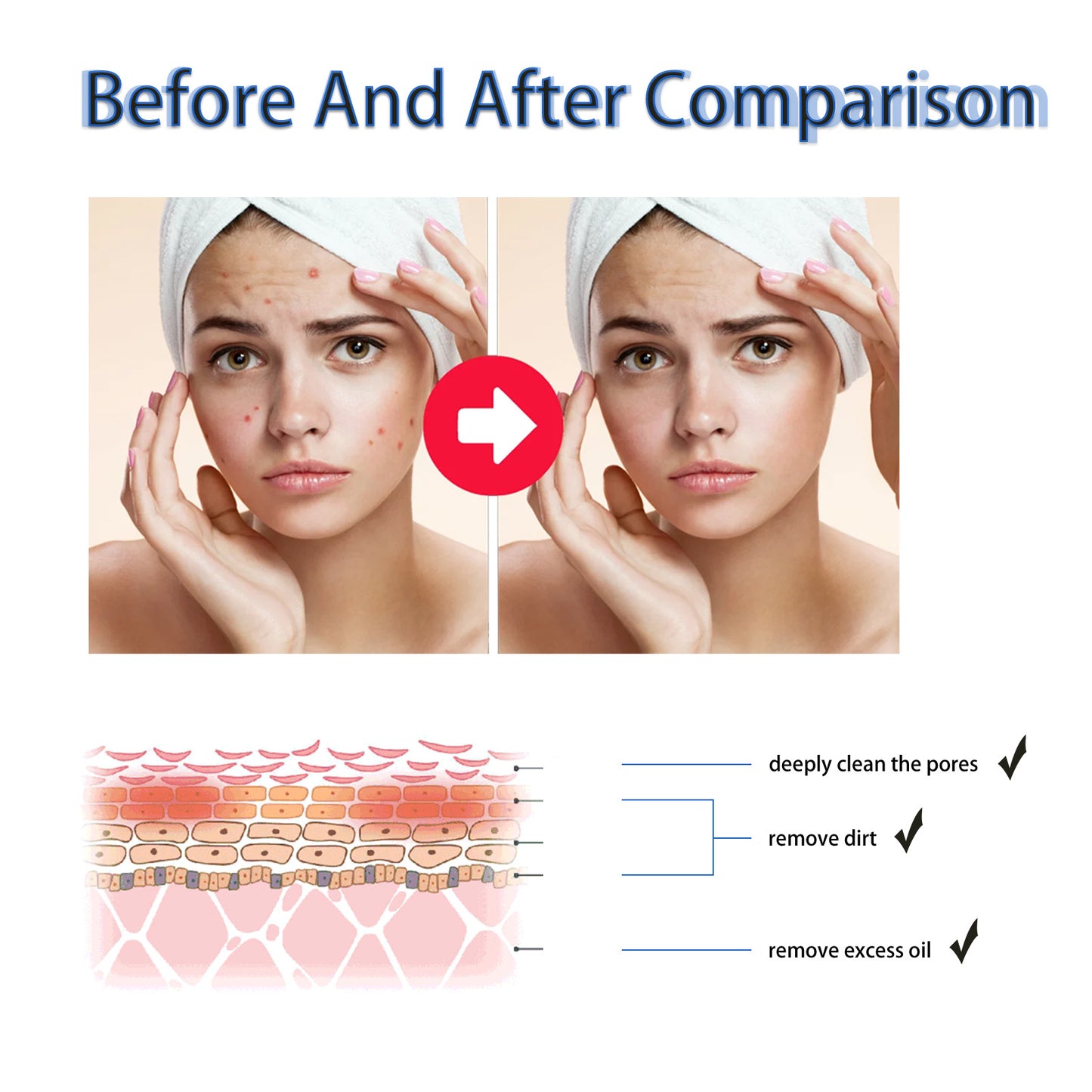 Ouhoe Facial Acne Removal Gel သည် နက်ရှိုင်းစွာ သန့်စင်ပေးပြီး ဝက်ခြံအမည်းစက်များနှင့် ဝက်ခြံများကို သက်သာပျောက်ကင်းစေသော အစိုဓာတ်ထိန်း Gel ၊