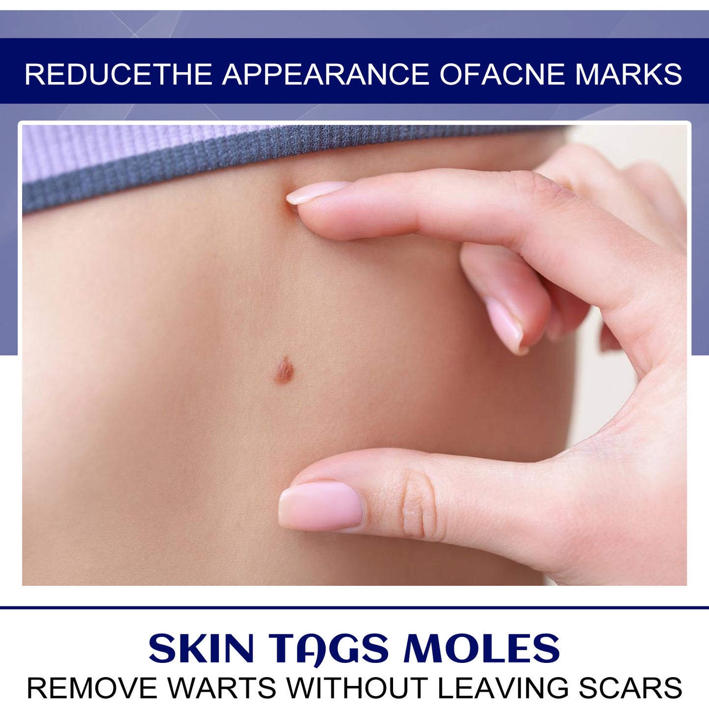 OUHOE Skin Tag Fading Cream Corns Cream Care Clean Skin Body Face Flat Uke Wart Cream