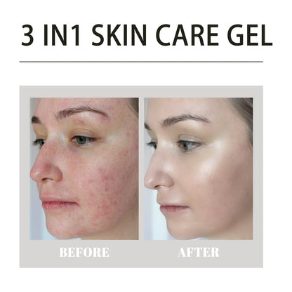 Ouhoe Facial Acne Removal Gel သည် နက်ရှိုင်းစွာ သန့်စင်ပေးပြီး ဝက်ခြံအမည်းစက်များနှင့် ဝက်ခြံများကို သက်သာပျောက်ကင်းစေသော အစိုဓာတ်ထိန်း Gel ၊ 