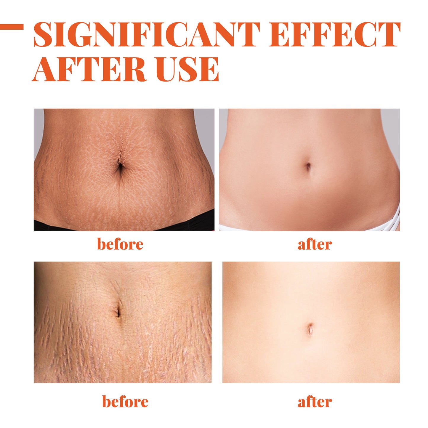 EELHOE Stretch Mark Repair and Removal Essential Oil for Pregnant Women Lifts and Firms Loose Lines and Removes Pregnancy Skin Care Essence 