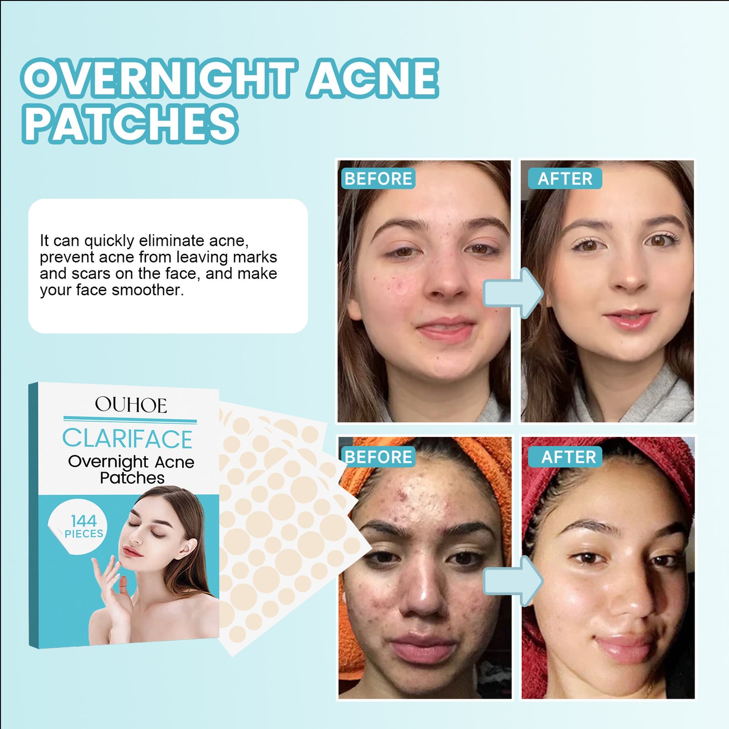 OUHOE Acne Patch သည် မျက်နှာတွင် ဝက်ခြံများကို ပျောက်ကင်းစေပြီး သက်သာပျောက်ကင်းစေပြီး concealer နှင့် လေဝင်လေထွက်ကောင်းသော ဝက်ခြံများကို ပိတ်စေသည် 