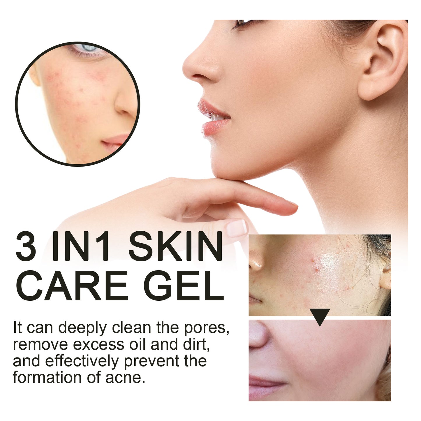 Ouhoe Facial Acne Removal Gel သည် နက်ရှိုင်းစွာ သန့်စင်ပေးပြီး ဝက်ခြံအမည်းစက်များနှင့် ဝက်ခြံများကို သက်သာပျောက်ကင်းစေသော အစိုဓာတ်ထိန်း Gel ၊ 