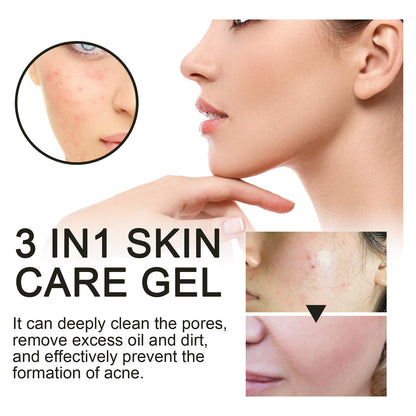 Ouhoe Facial Acne Removal Gel သည် နက်ရှိုင်းစွာ သန့်စင်ပေးပြီး ဝက်ခြံအမည်းစက်များနှင့် ဝက်ခြံများကို သက်သာပျောက်ကင်းစေသော အစိုဓာတ်ထိန်း Gel ၊ 