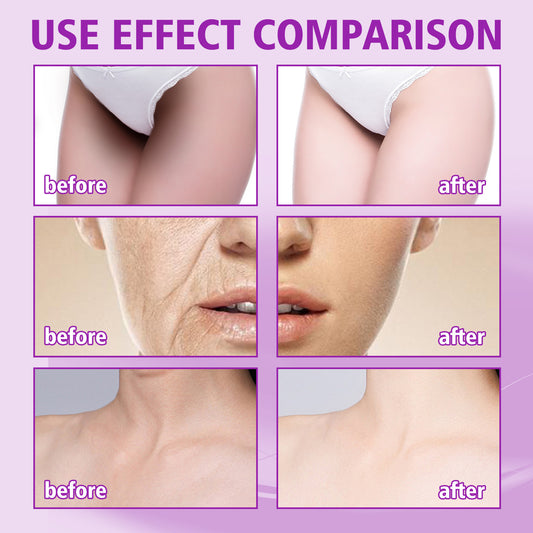 OUHOE anti-aging cream သည် nasolabial folds ၊ မျက်လုံးနှင့်လည်ပင်းတစ်ဝိုက်ရှိ လိုင်းကောင်းများကို ပျောက်ကင်းစေကာ တင်းရင်းစေခြင်း၊ အရေးအကြောင်းများကို တားဆီးပေးပြီး မျက်နှာအသားအရေကို တင်းရင်းစေသည် 